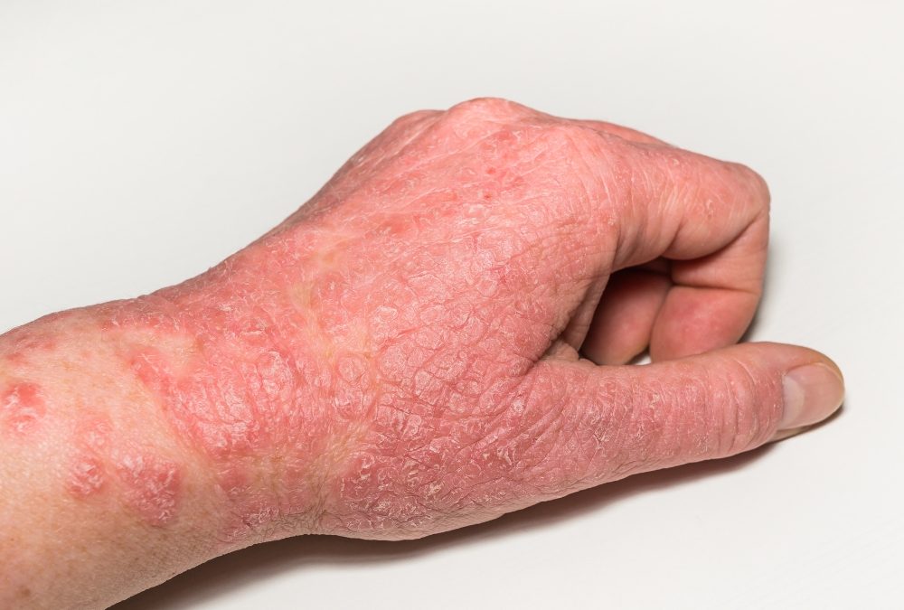 Understanding Eczema and What Your Skin is Telling You: