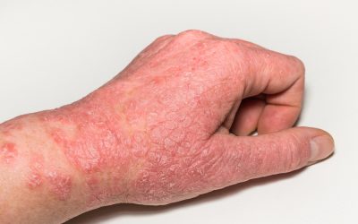 Understanding Eczema and What Your Skin is Telling You: