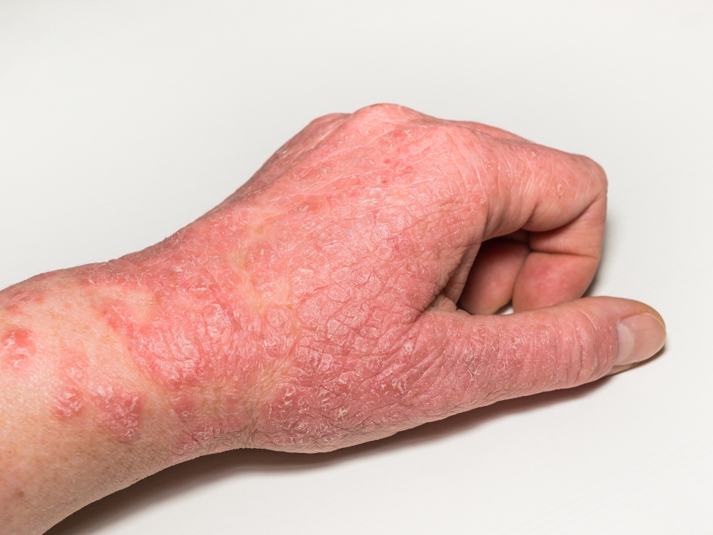 understanding eczema and what your skin is telling you