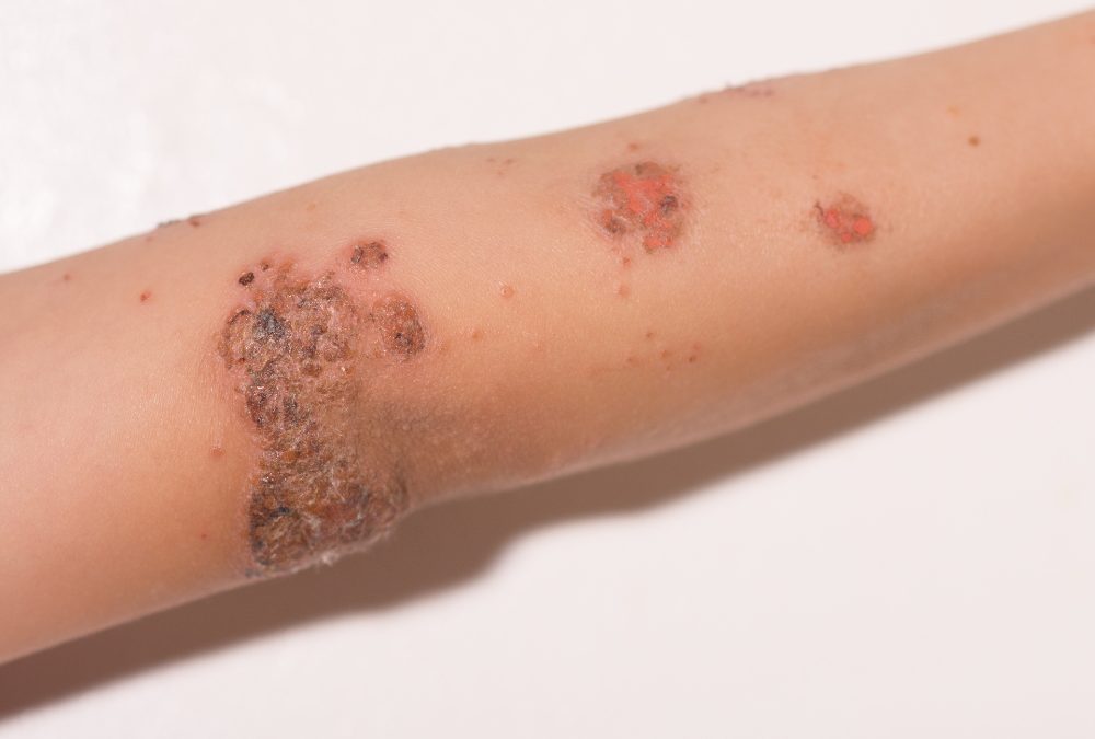 Impetigo Uncovered The Skin Infection You Shouldn’t Ignore: