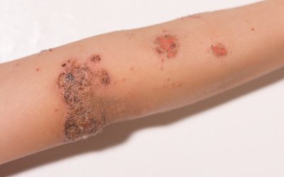 Impetigo Uncovered The Skin Infection You Shouldn’t Ignore: