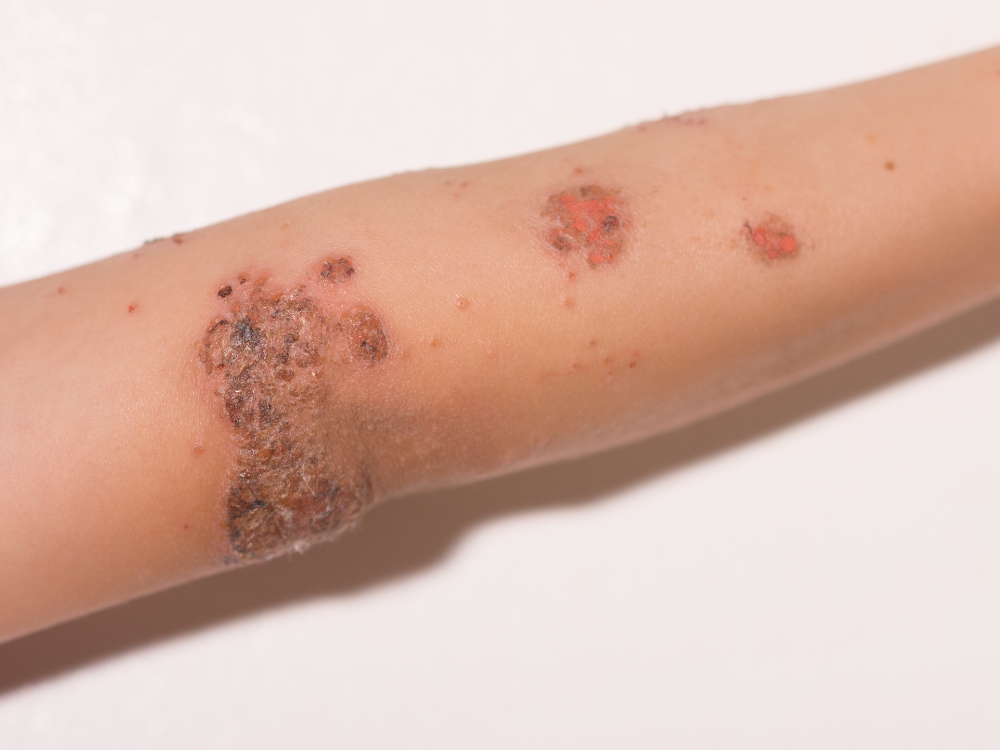 signs and symptoms of diagnosed impetigo skin infection