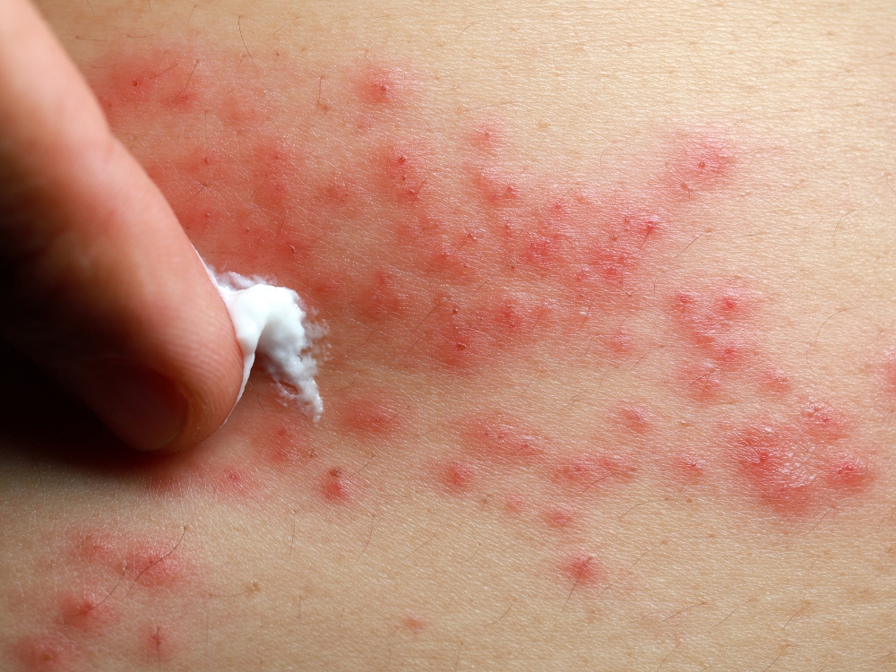 how can i ease and prevent eczema flare-ups