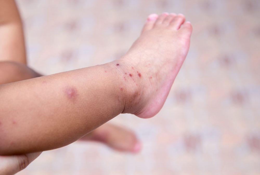 Navigating Hand, Foot, and Mouth Disease with Your Little Ones