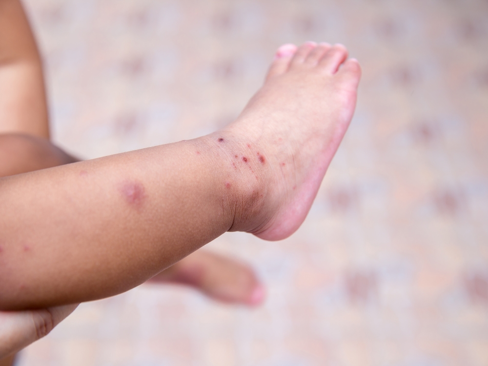 navigating hand foot and mouth disease